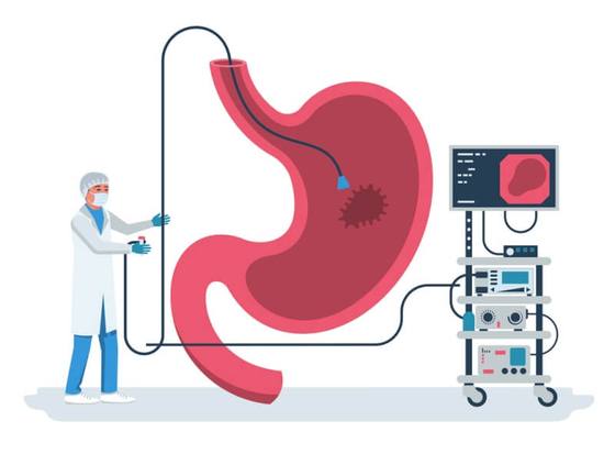 Ilustração do procedimento de endoscopia digestiva alta avaliando o estômago